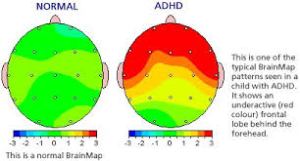 ADHD Feiten en fabels-adhd-no adhd-hwmcoaching